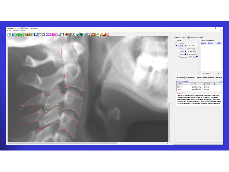 Vertebral Analysis